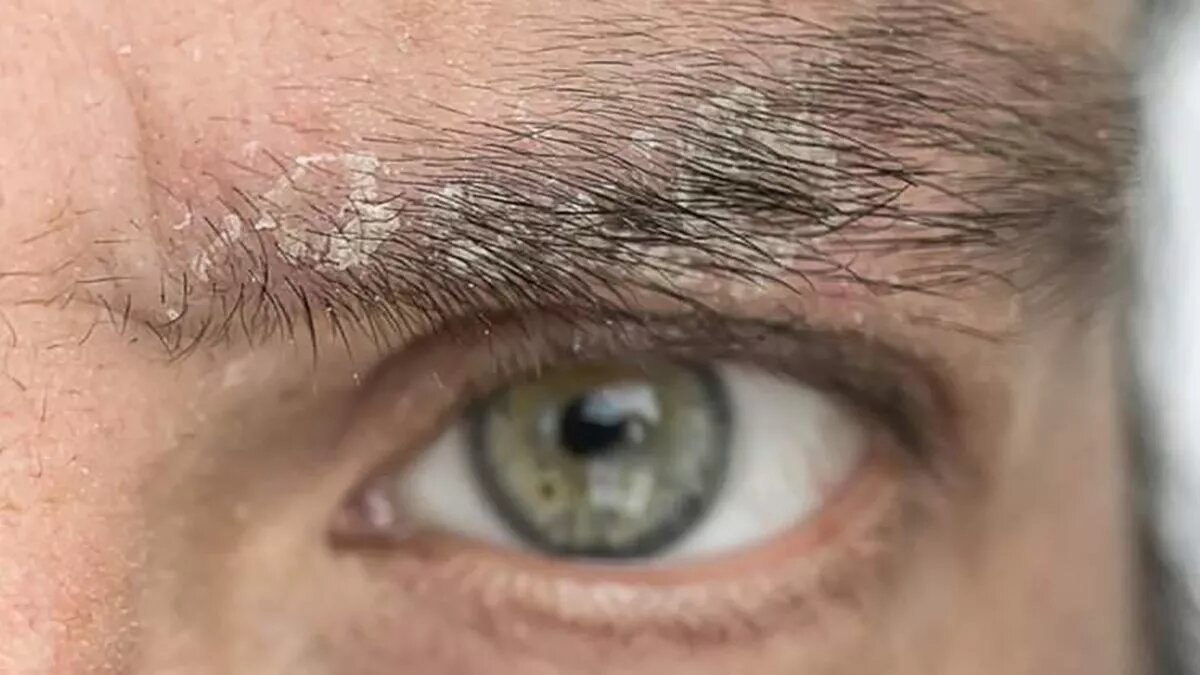 ¿Qué es la dermatitis seborreica y cuáles son sus causas? Farmacia